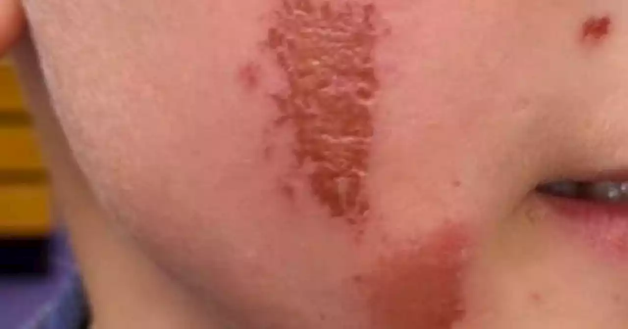 Mum's warning after son comes home from school with horrific burns