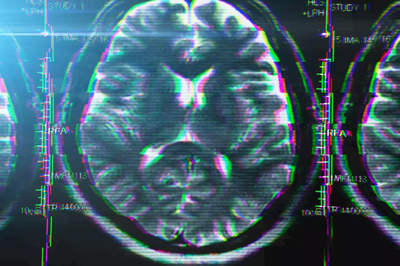 COVID-19 Positive Patients at Far Higher Risk of Developing Serious Neurodegenerative Disorders