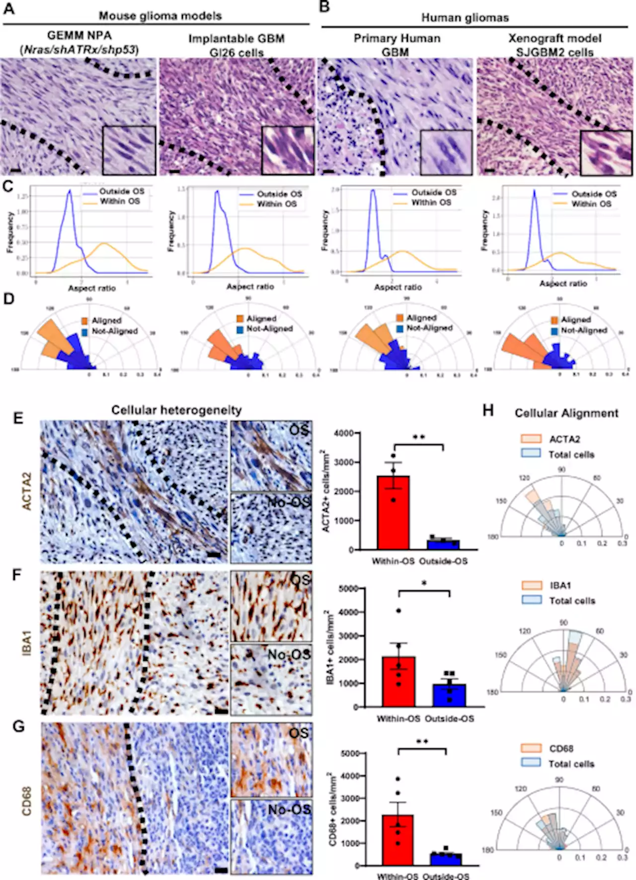 Spatiotemporal analysis of glioma heterogeneity reveals COL1A1 as an actionable target to disrupt tumor progression - Nature Communications