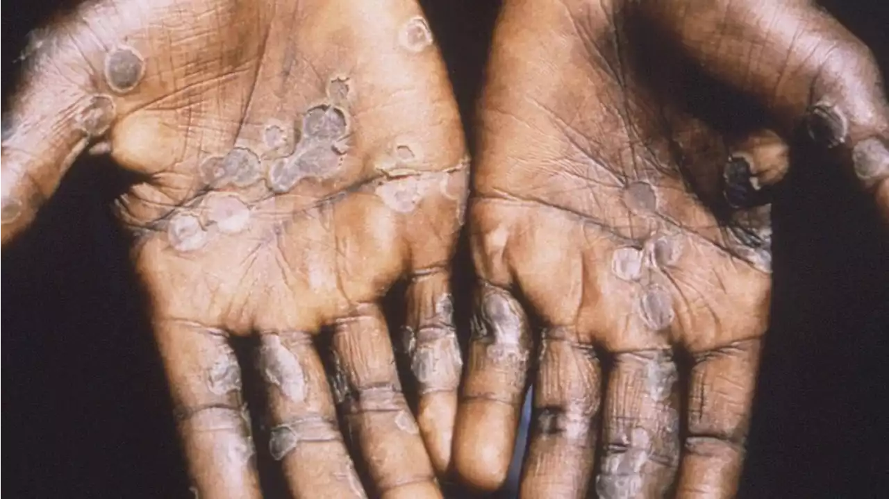 Second monkeypox case identified in Ohio