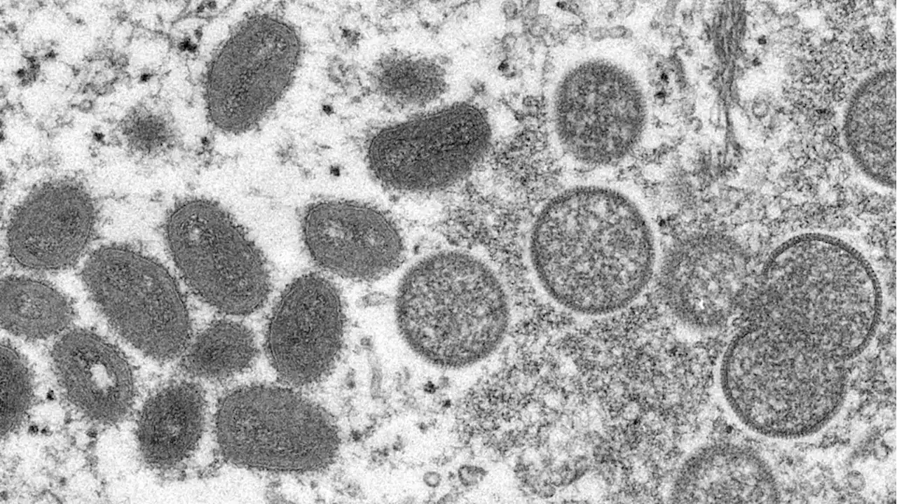 U.S. set to offer monkeypox vaccines in states with high case rates