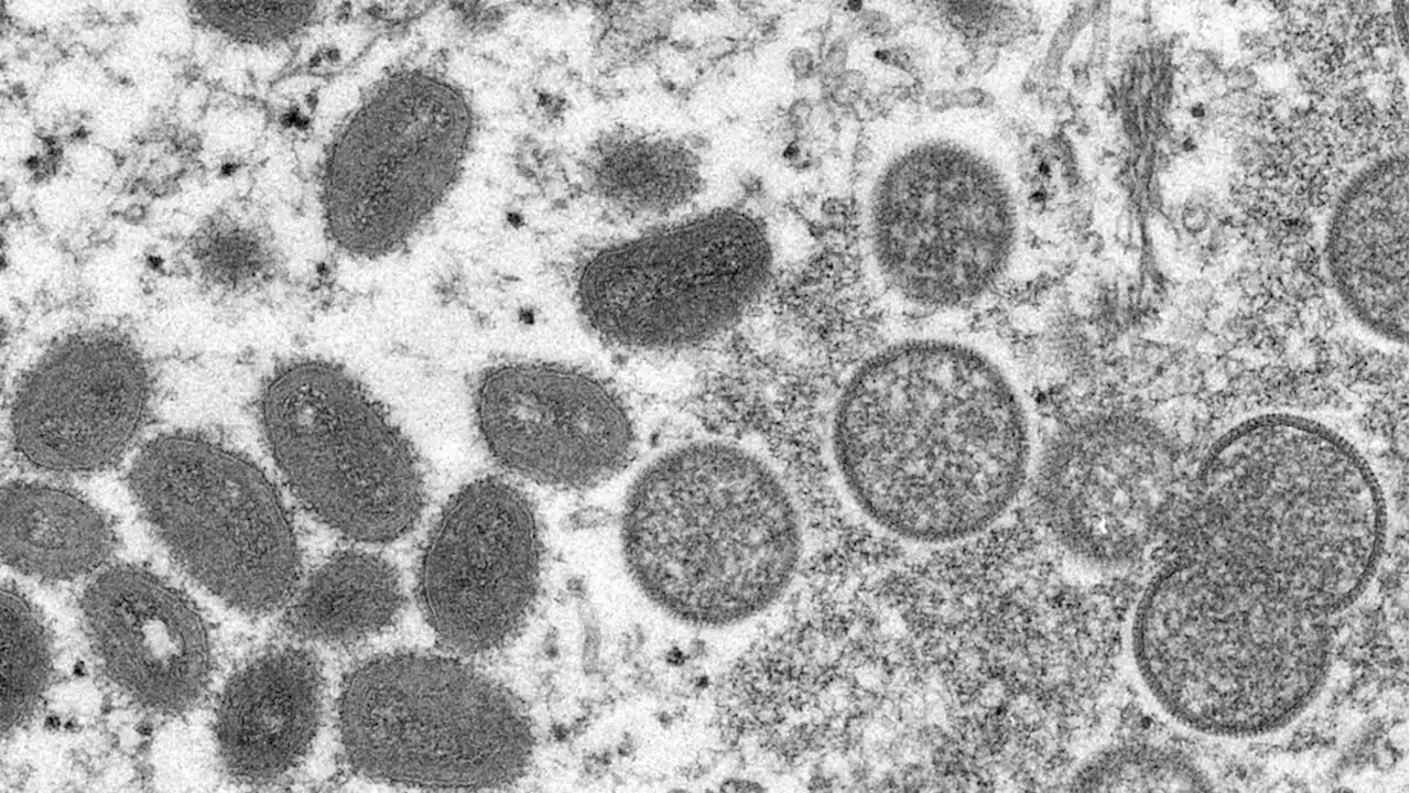 Silent spread of monkeypox may be a wakeup call for the world