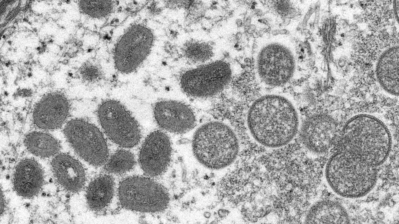 First probable case of monkeypox reported in Illinois