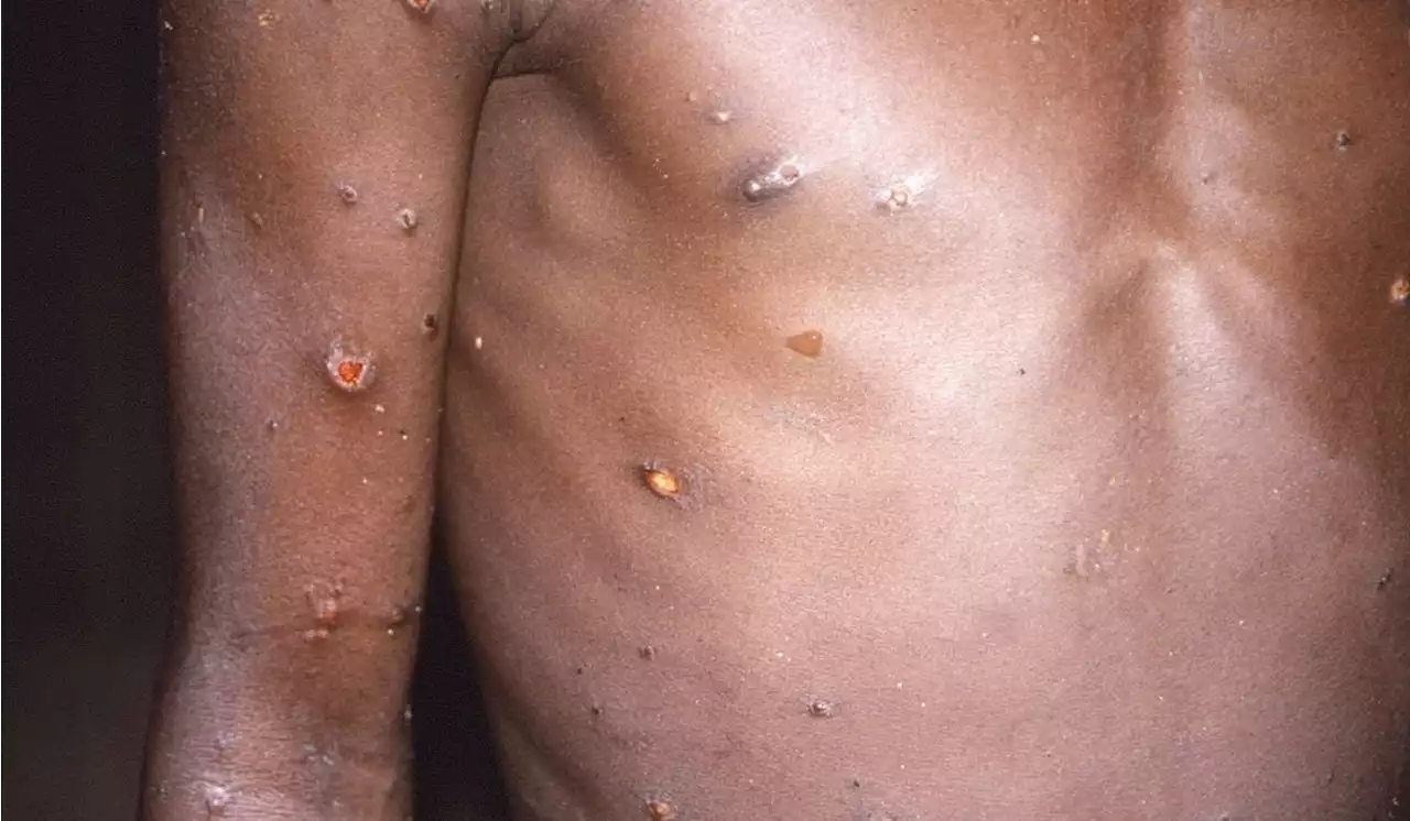 Monkeypox outbreak needs a united response, says WHO Africa