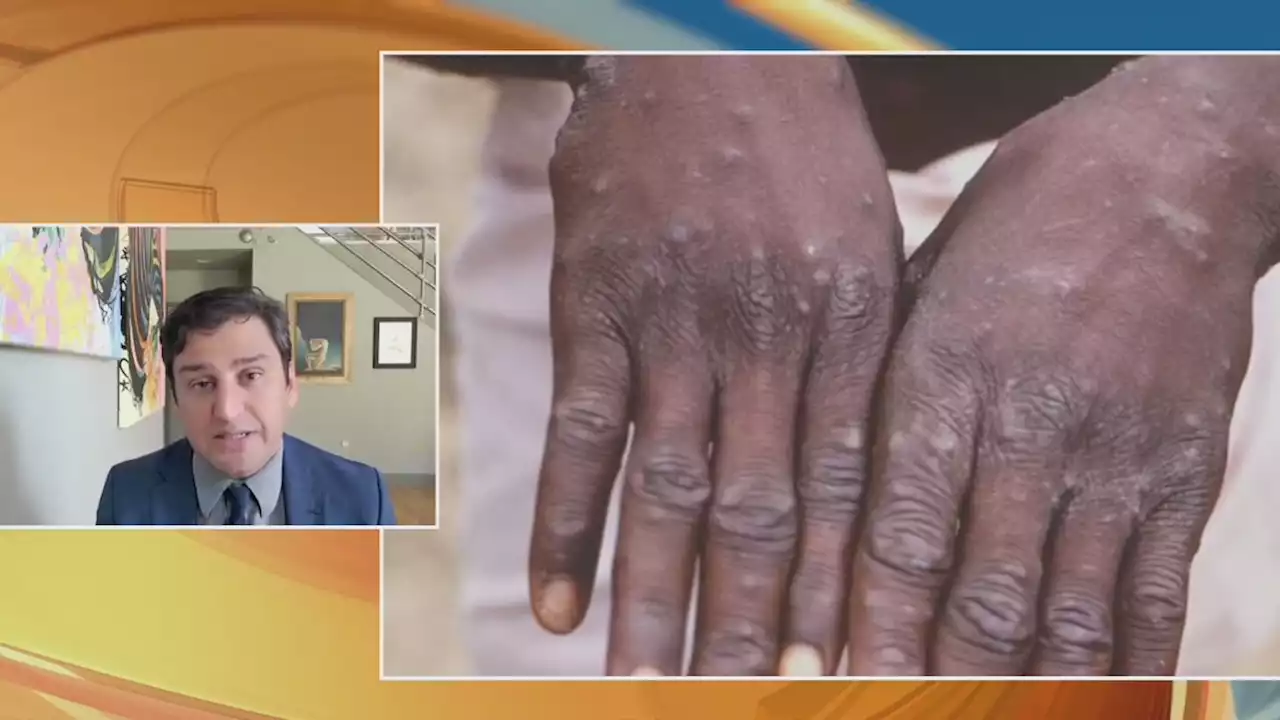 Infectious disease doctor discusses monkeypox outbreak and vaccines