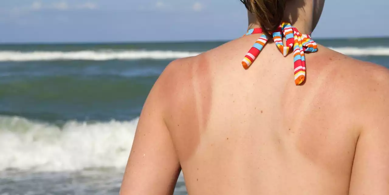 The Tips for Helping a Sunburn Heal Fast? Doctors Say There Are a Few Things You Can Do