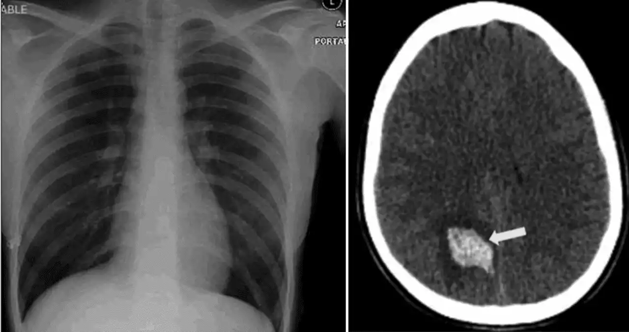 Hemorragia intracraneal espontánea por COVID-19 en una joven puertorriqueño de 23 años