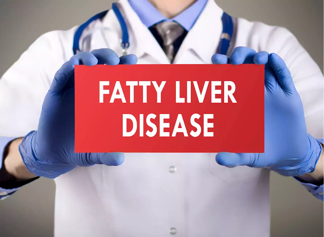 What Is Fatty Liver Disease? These Are the Signs You May Have It — Eat This Not That