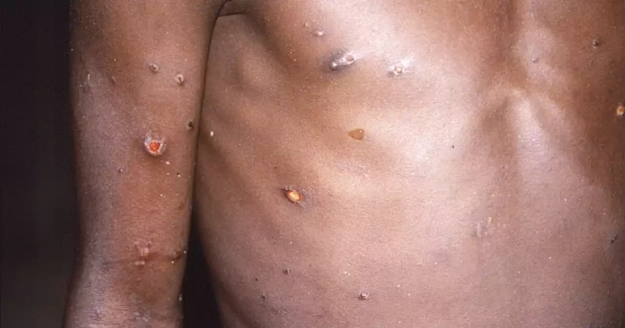 San Francisco reports first suspected monkeypox case