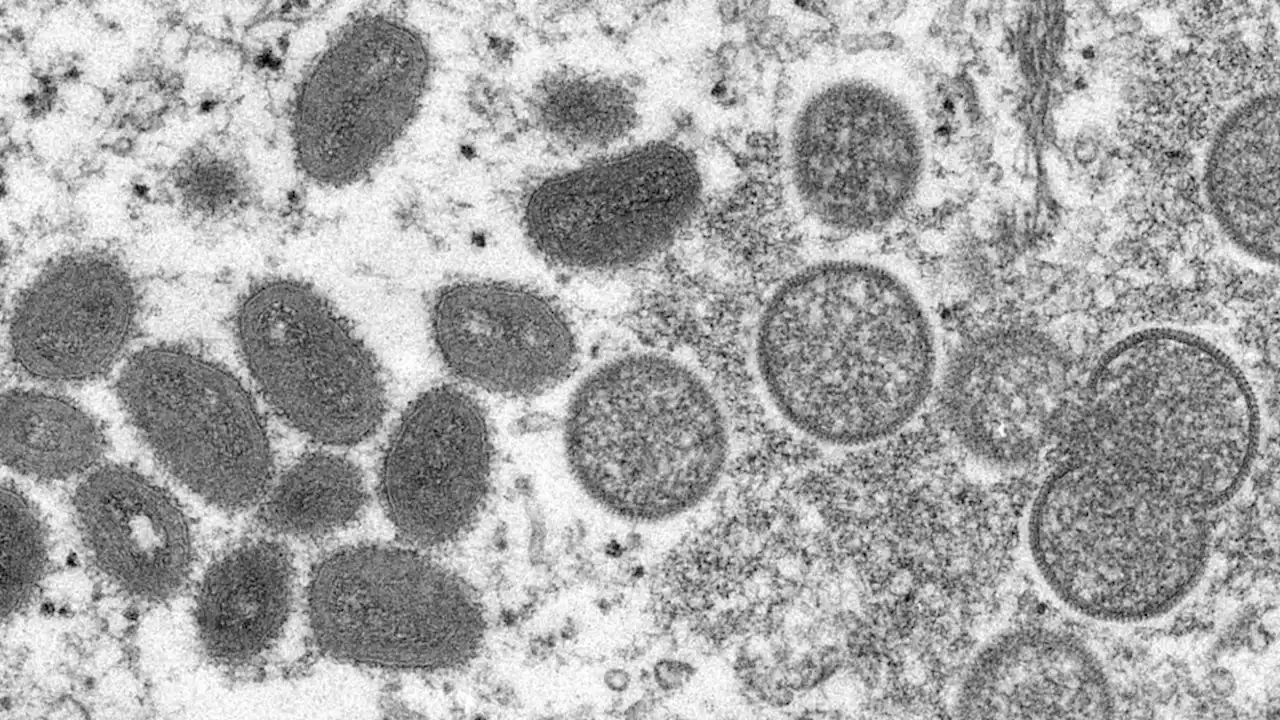 First probable case of monkeypox identified in San Francisco resident