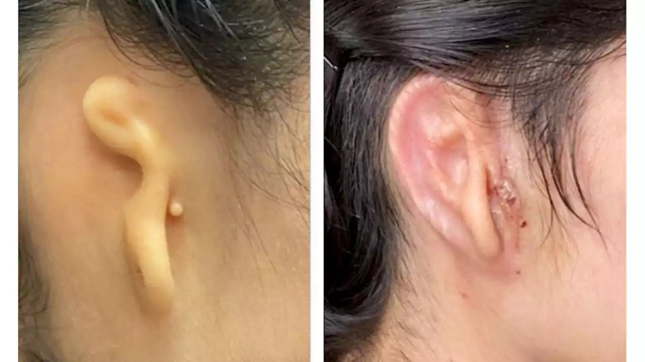 In a medical first, woman receives 3D-printed ear transplant from her own cells