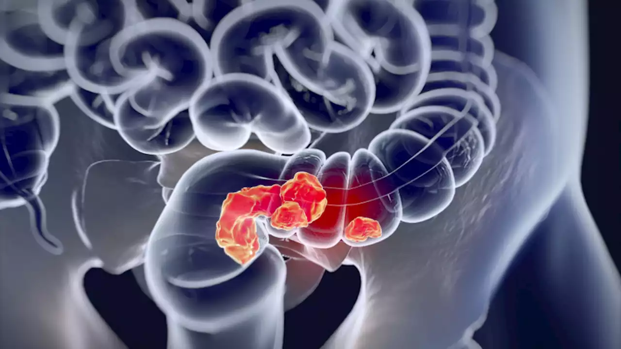 A breakthrough drug trial astonished doctors by curing rectal cancer in each patient