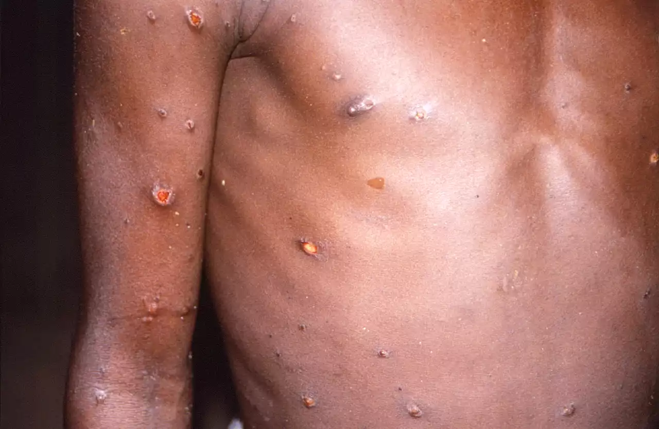 Monkeypox cases in U.S. primarily among 'men who have sex with men': CDC