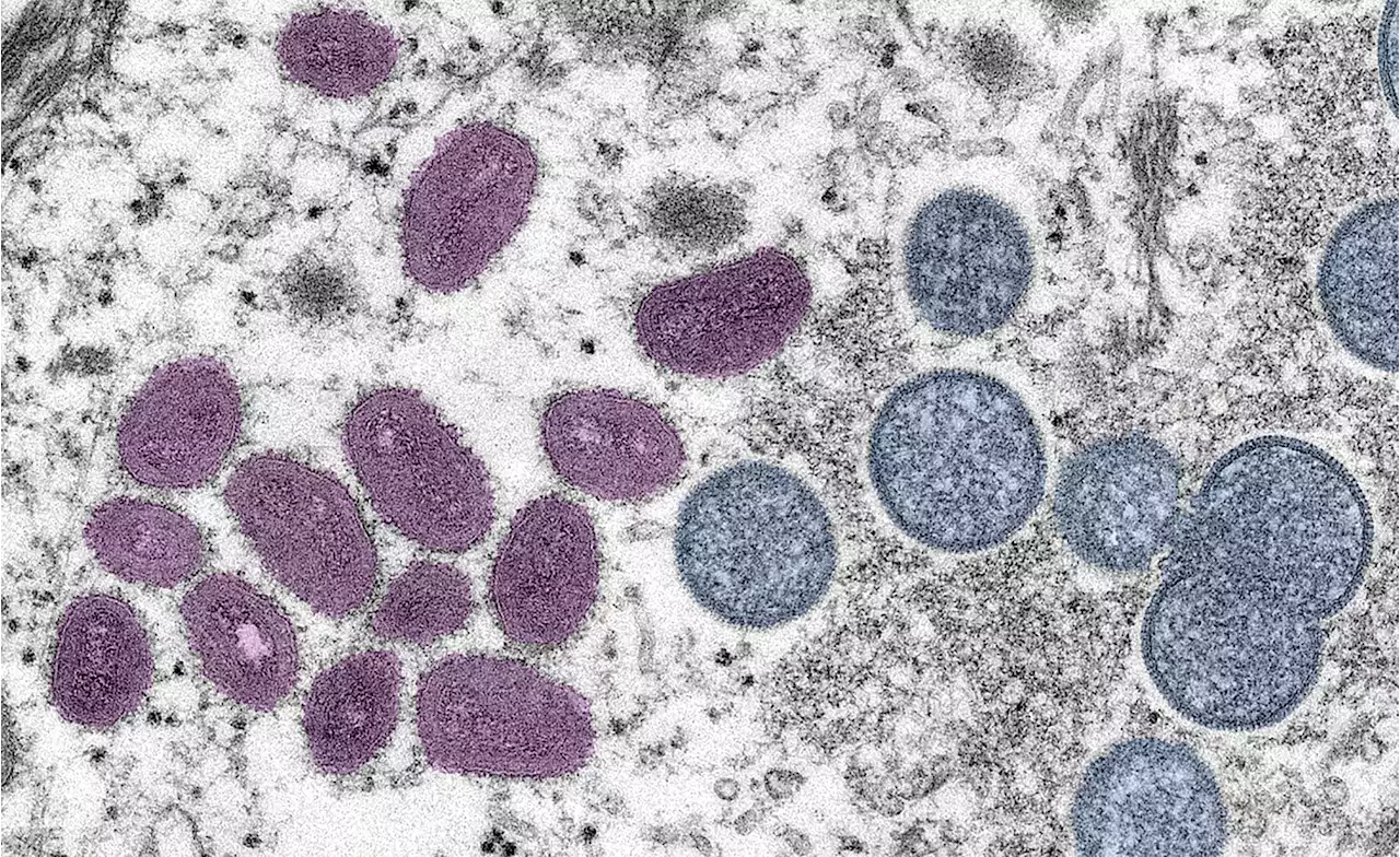 CDC Raises Travel Alert As Monkeypox Cases Grow