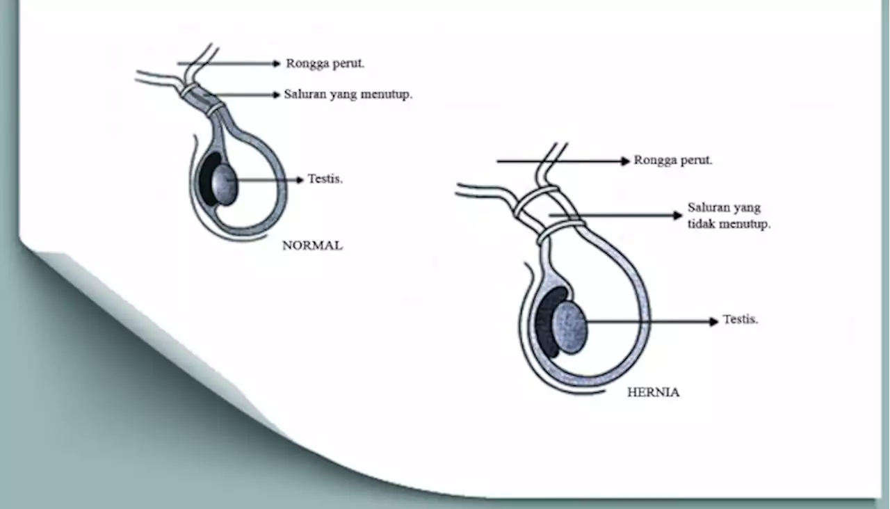 Mengenal Hernia dan Jenisnya