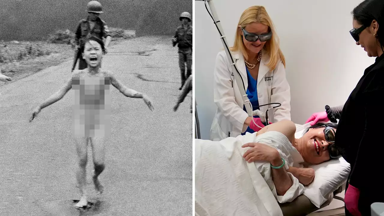 Kim Phuc, Vietnam War 'Napalm Girl,' Gets Final Burn Treatment 50 Years Later