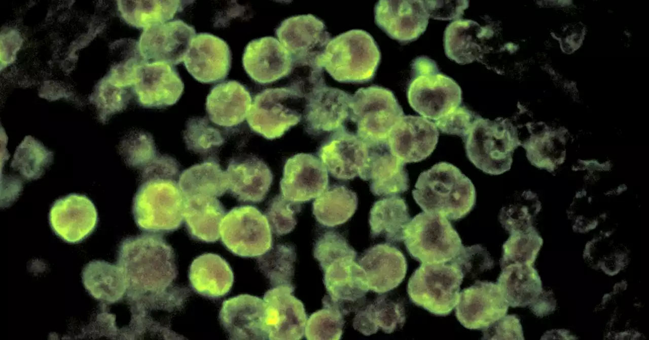 Iowa beach closes after visitor infected with life-threatening, brain-eating amoeba