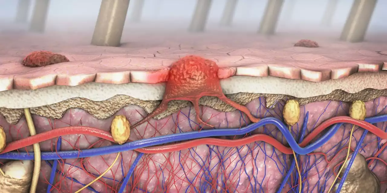 Melanoma and Skin Cancer Highlights From ASCO 2022