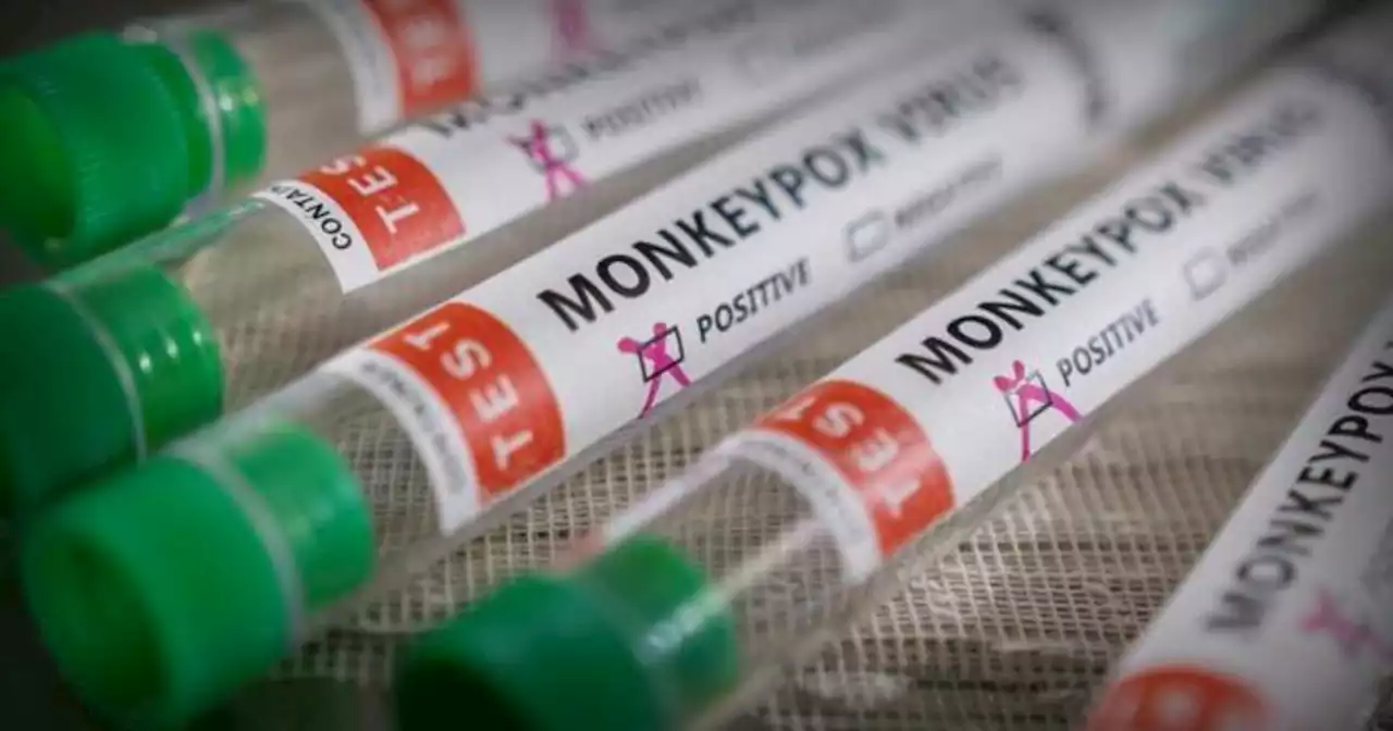 Long Beach reports its first suspected case of monkeypox