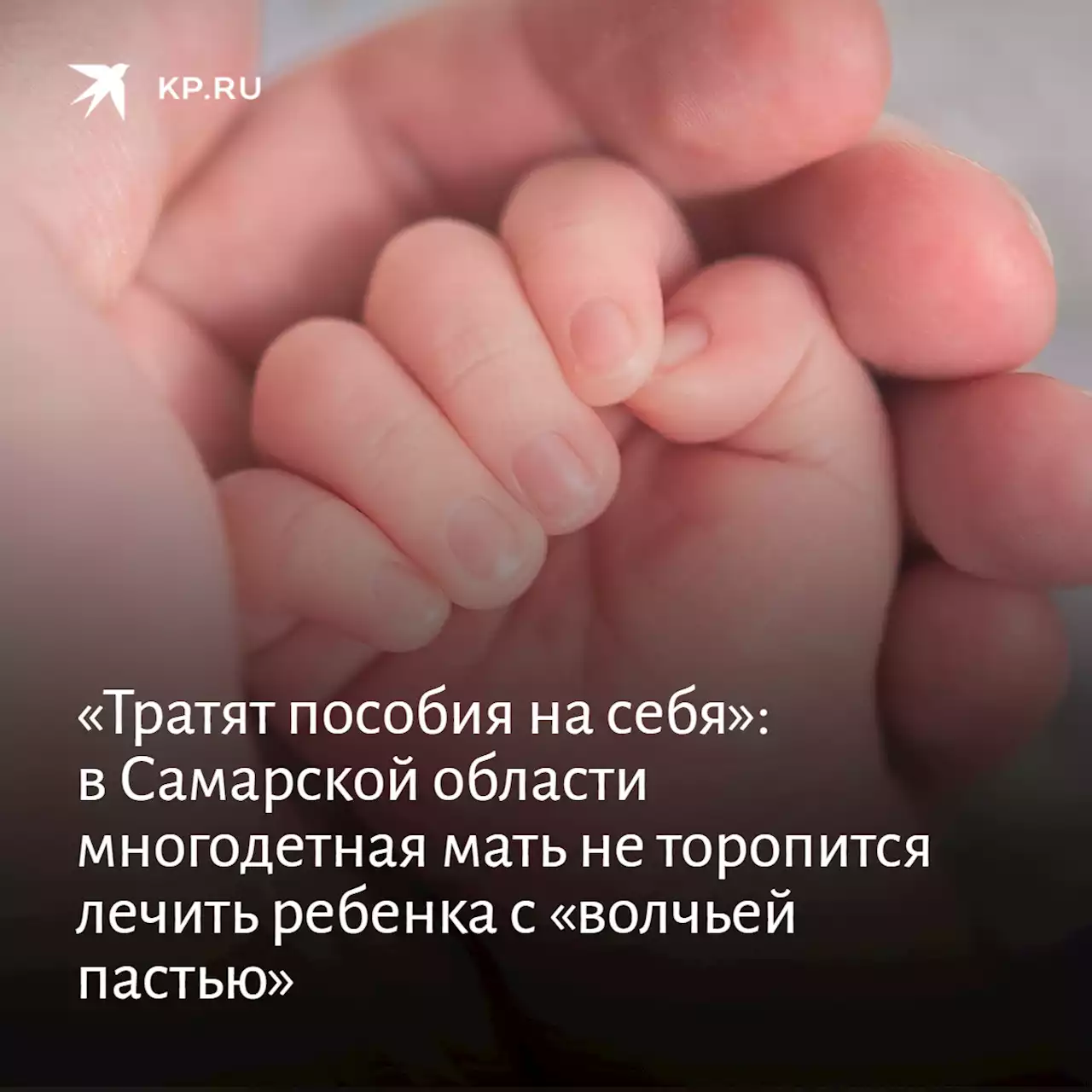 «Тратят пособия на себя»: в Самарской области многодетная мать не торопится лечить ребенка с «волчьей пастью»