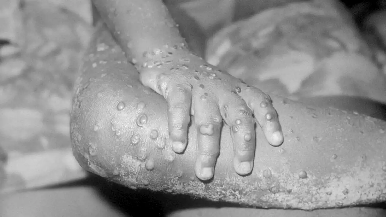 Long Beach reports first suspected case of monkeypox