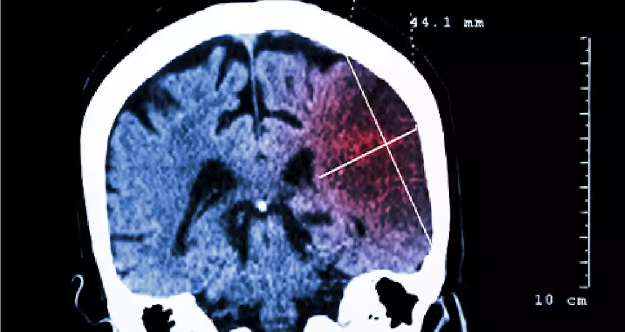 High Rate of Undiagnosed Major Risk Factors in Ischemic Stroke