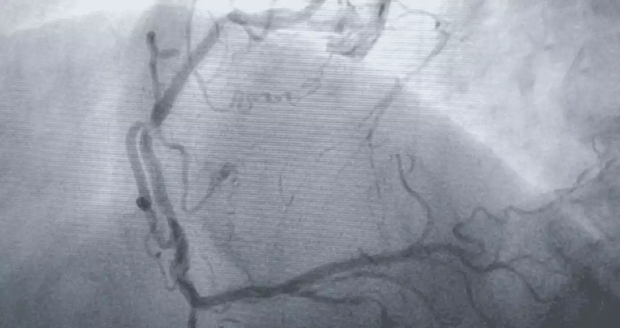 Investigadores revelan un gen clave en la reparación del corazón tras un infarto