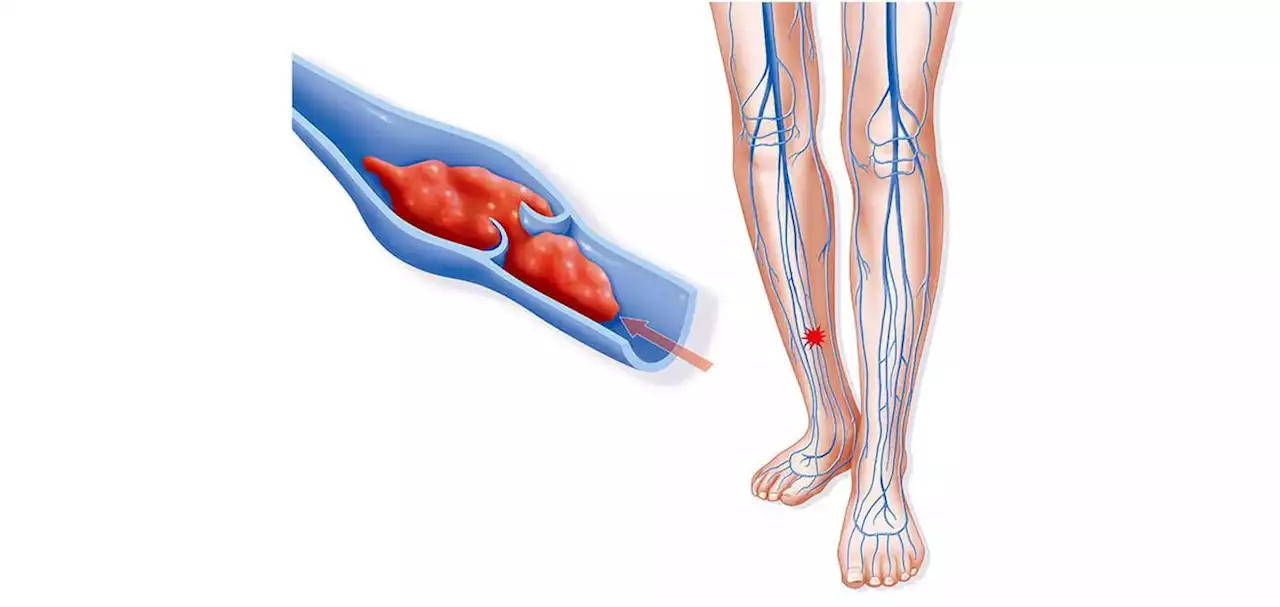 Venous Thromboembolism: Nonvitamin K Oral Anticoagulants Superior in Real World