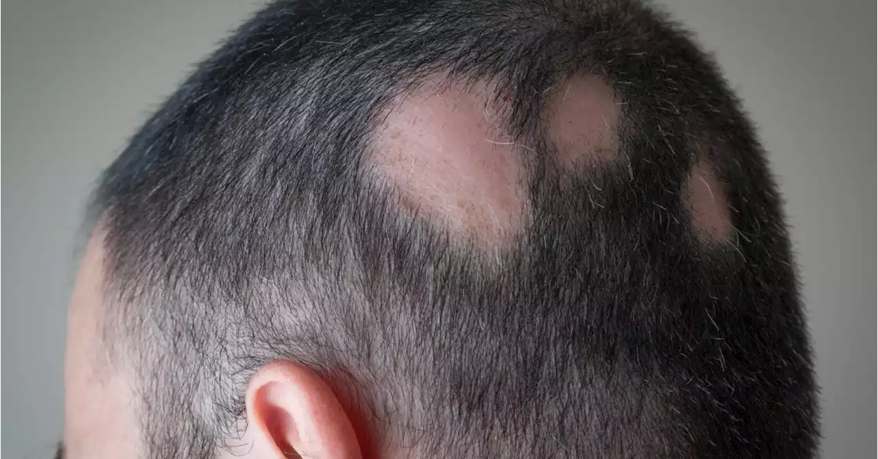 Future Is Brighter for Alopecia Treatment: Expert