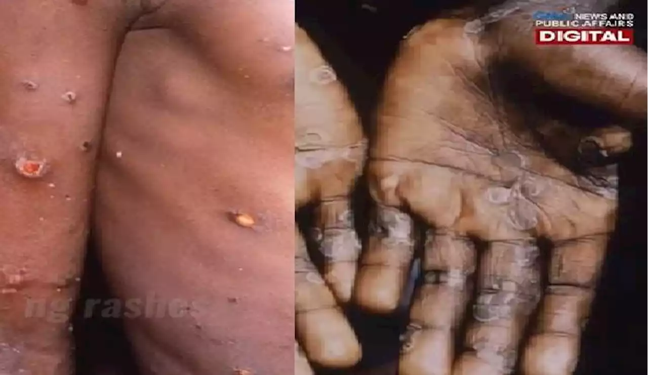 Thailand, may kaso na rin ng monkeypox