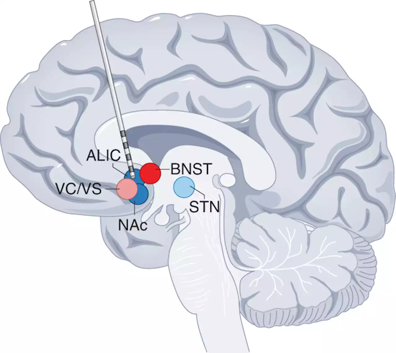 Deep brain stimulation for obsessive–compulsive disorder: a crisis of access - Nature Medicine