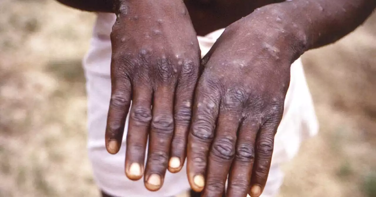 WHO emergency committee meets, considers declaring monkeypox a global emergency