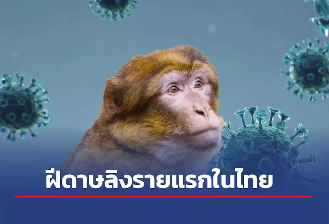 พบฝีดาษลิงรายแรกในไทย เป็นชาวไนจีเรีย