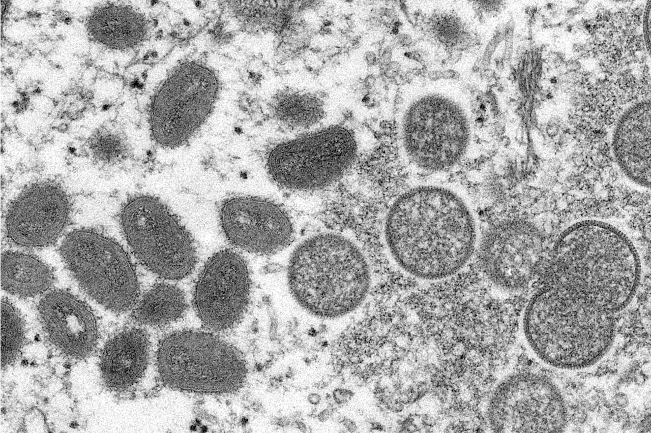 Monkeypox Virus Could Become Entrenched STD in the US