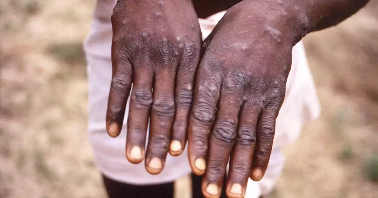 UN health agency declares monkeypox a global emergency