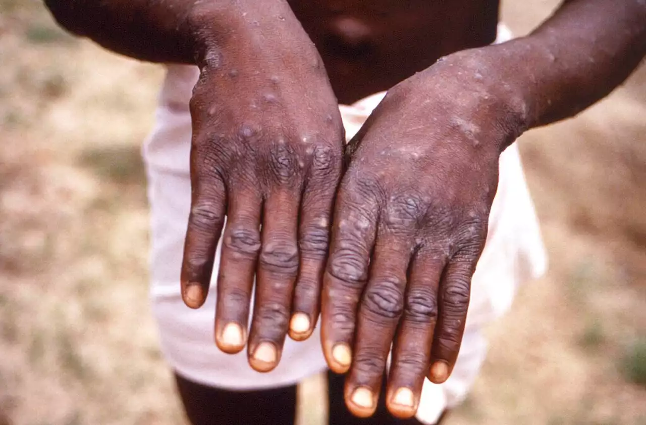 Monkeypox is now a global emergency, UN health agency says