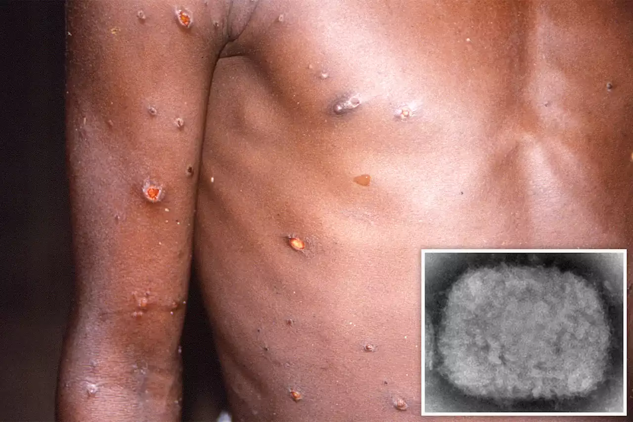 Two children diagnosed with monkeypox in US, officials say