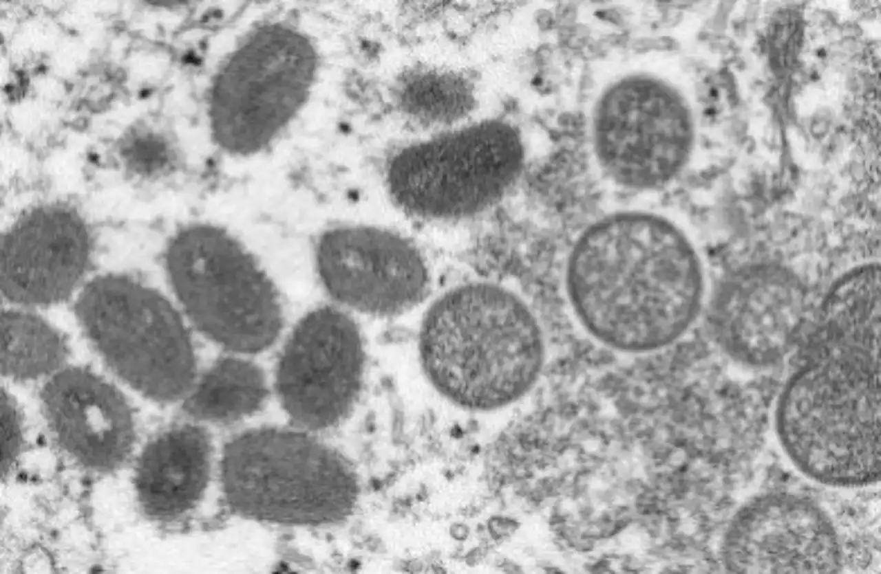 Monkeypox declared global health emergency by World Health Organization
