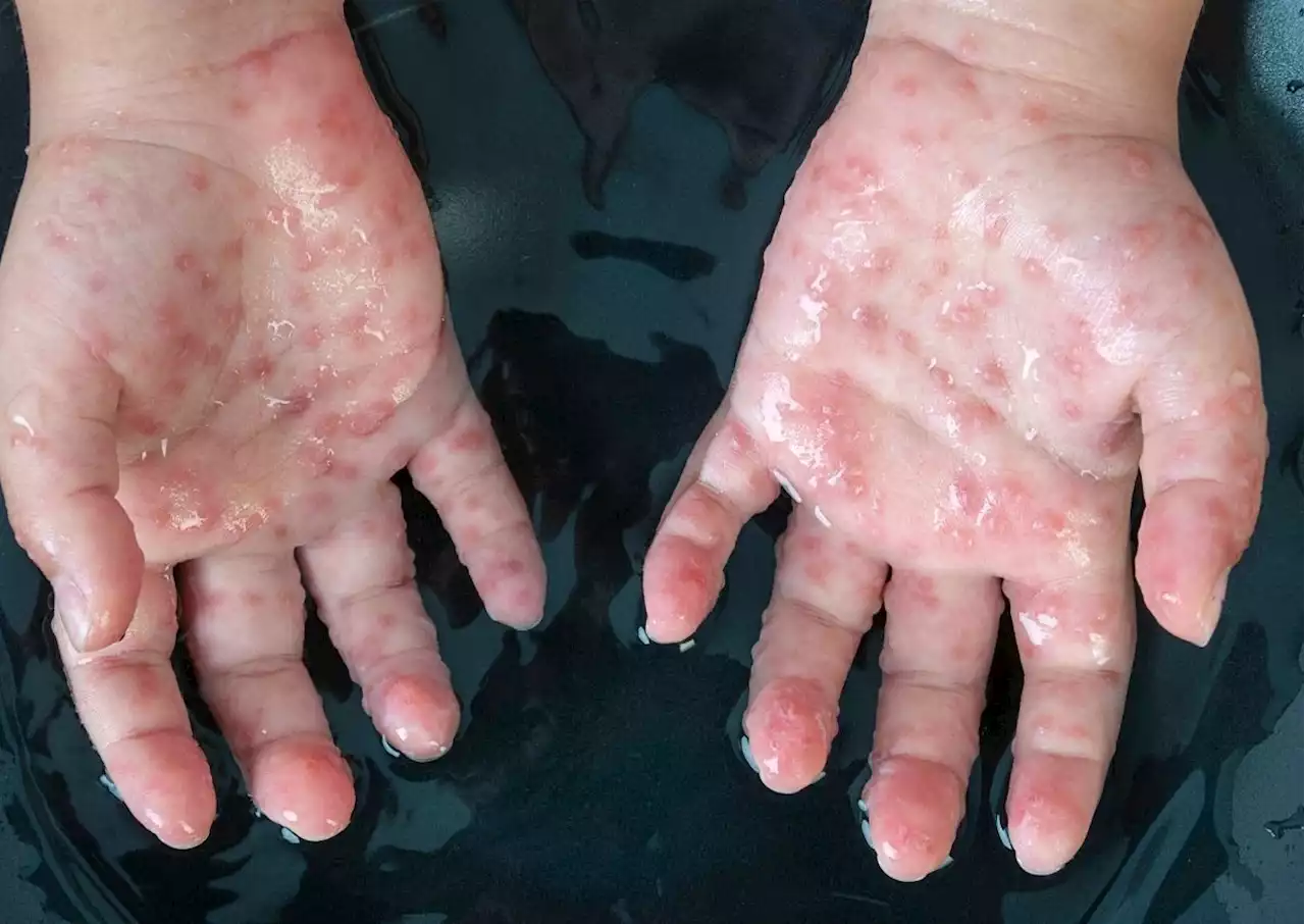 JUST IN: WHO declares Monkeypox a global health emergency