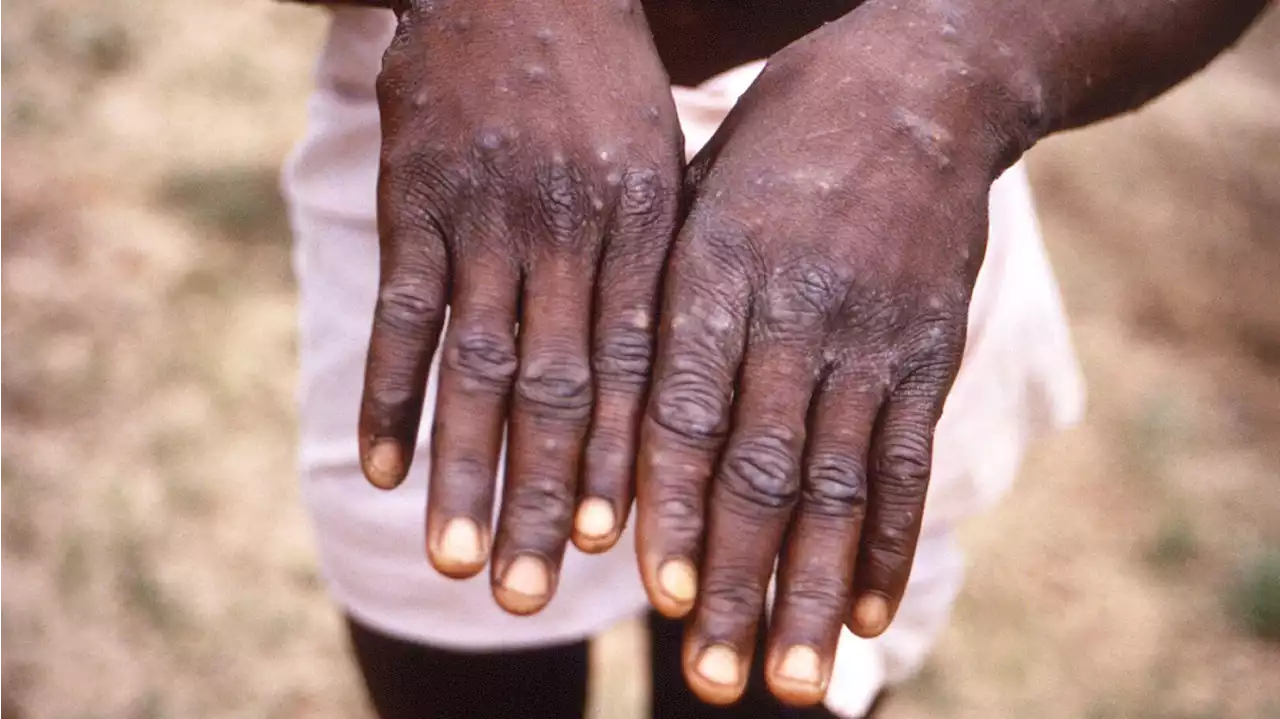 UN health agency declares monkeypox a global emergency