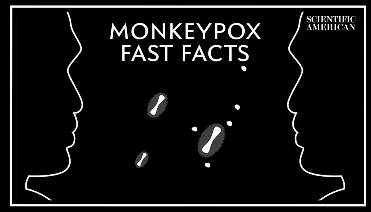 5 Things to Know about Monkeypox