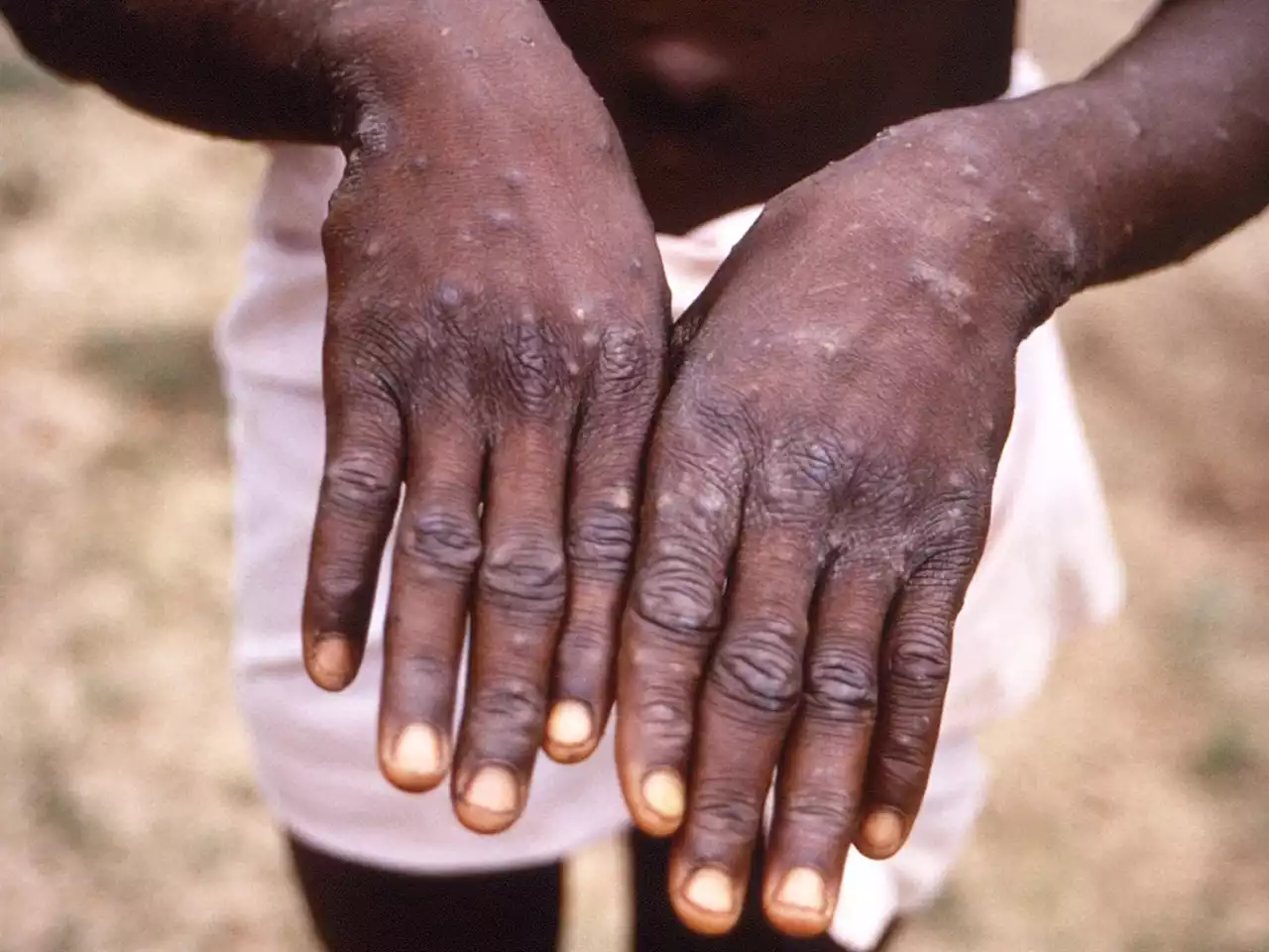 What to know about monkeypox symptoms as the virus spreads in an unusual way across the US, Europe | Businessinsider