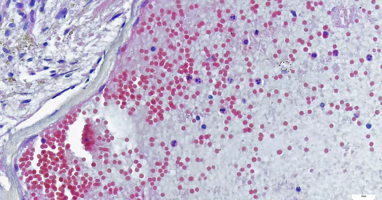 The unsuspecting signs of Monkeypox from high temperature to tiredness