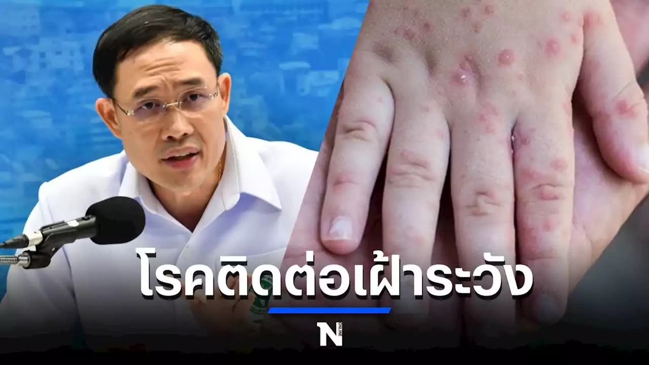 สธ. ไม่ยกระดับ “ฝีดาษลิง” เป็น “โรคติดต่ออันตราย”