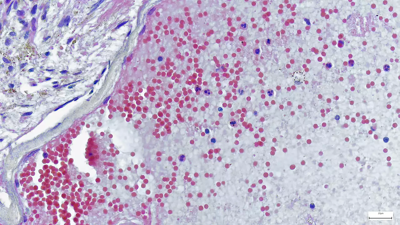 What You Need to Know About Monkeypox