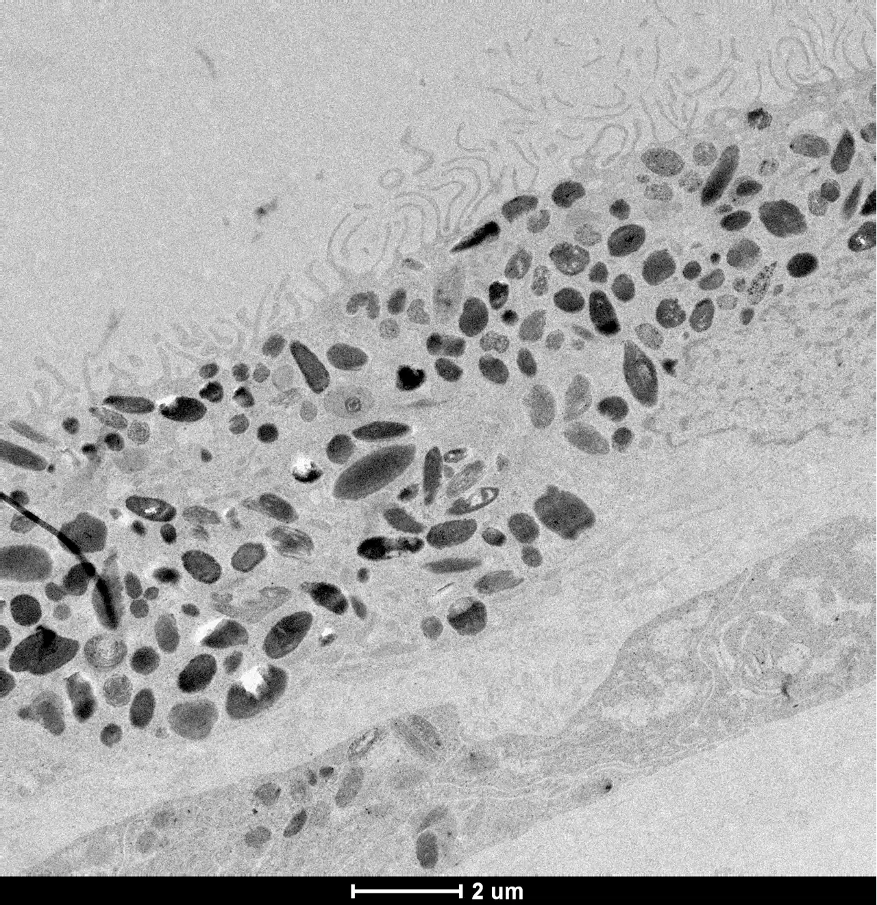 Genetic clues to age-related macular degeneration revealed