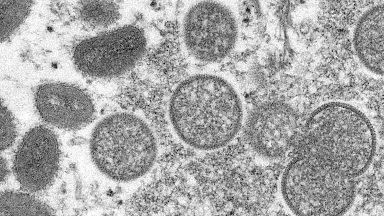 Two Children Diagnosed With Monkeypox in US, Officials Say