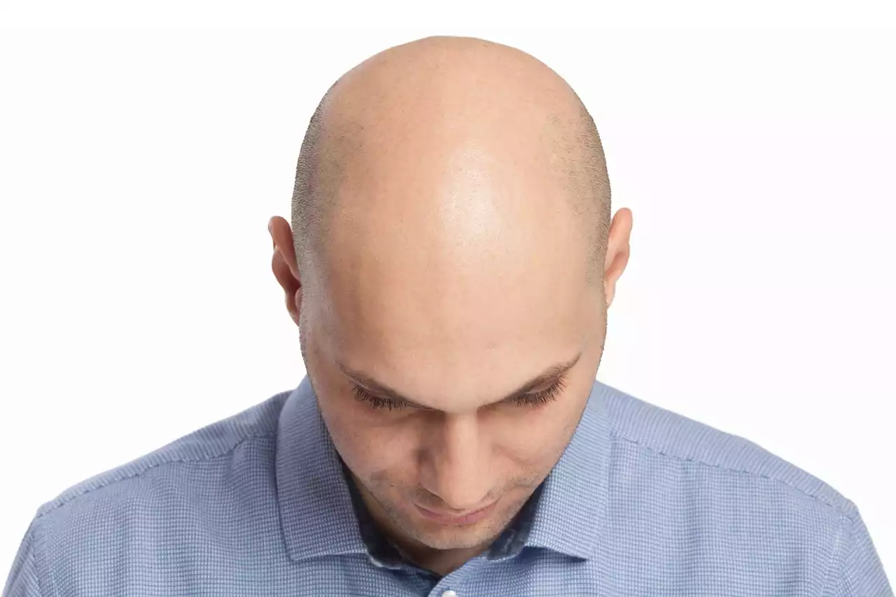 Potential Cure for Baldness: Discovery of Chemical Controlling Life and Death in Hair Follicles