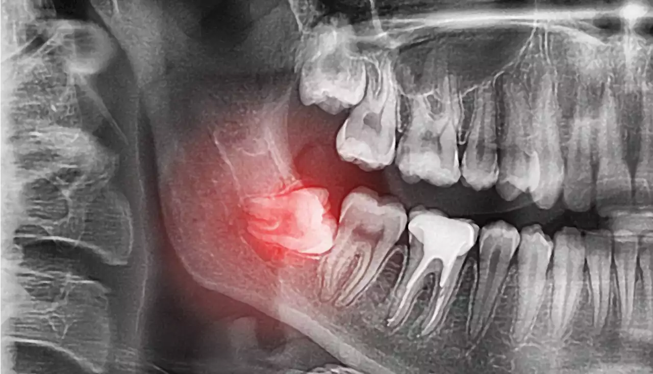 Do wisdom teeth serve any other purpose than causing pain?