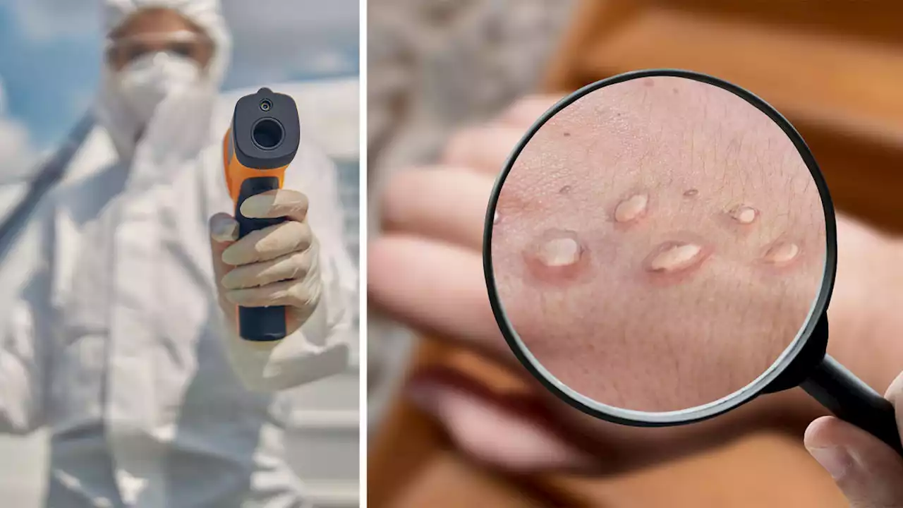 What to know about monkeypox and the situation in Singapore (updated 26 July)